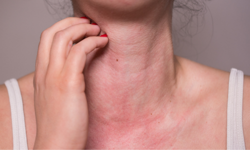 写真_金属アレルギー