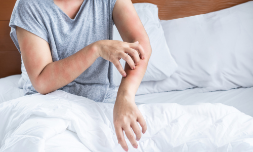 写真_ダニ（ハウスダスト）アレルギー