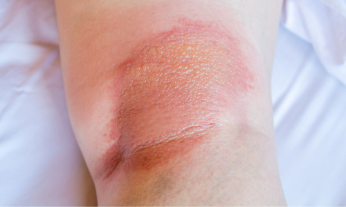 写真_かぶれ（接触皮膚炎）