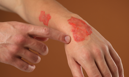 写真_やけど（熱傷）