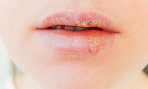 写真_ヘルペスウイルス感染症