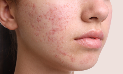 写真_ニキビ・ニキビ跡