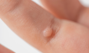 写真_小児のウイルス性イボ