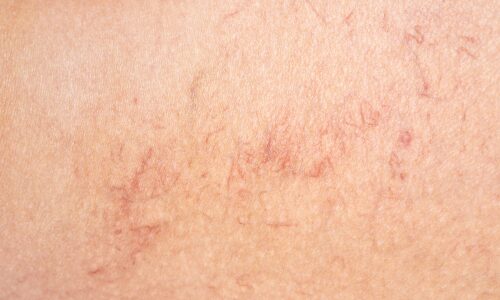 写真_毛細血管拡張症