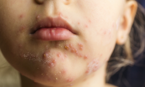 写真_水ぼうそう