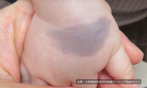 写真_異所性蒙古斑