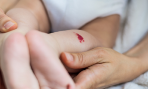 写真_血管腫（赤あざ）