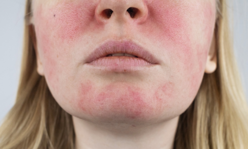 写真_赤ら顔（酒さ）